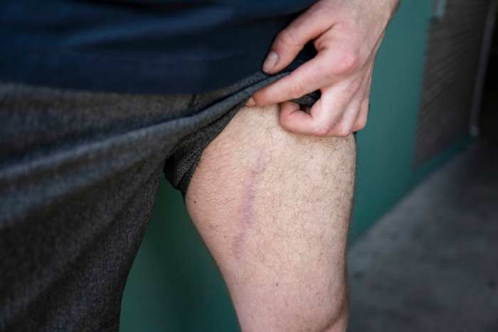 A decade later, the bullet is still inside Donohue’s leg.